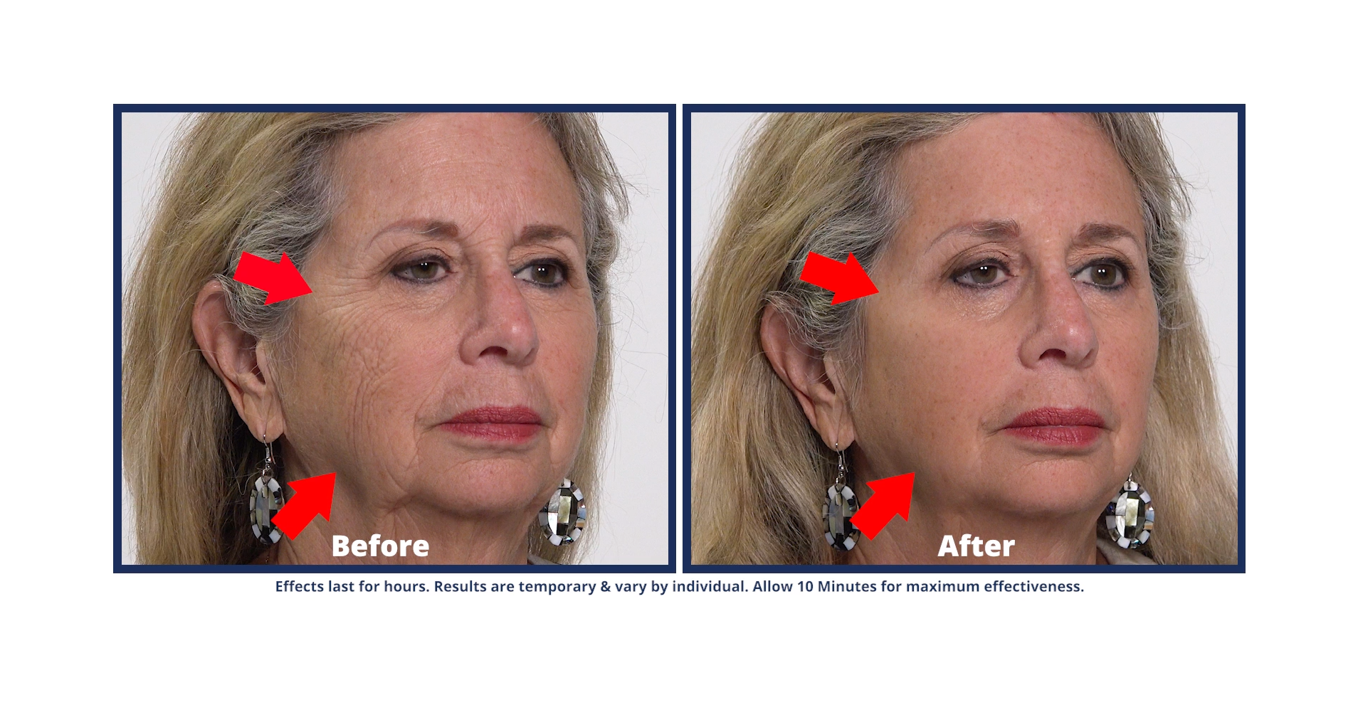 Plexaderm Promises Visible Difference In Under-eye Bags, Wrinkles In 10 ...