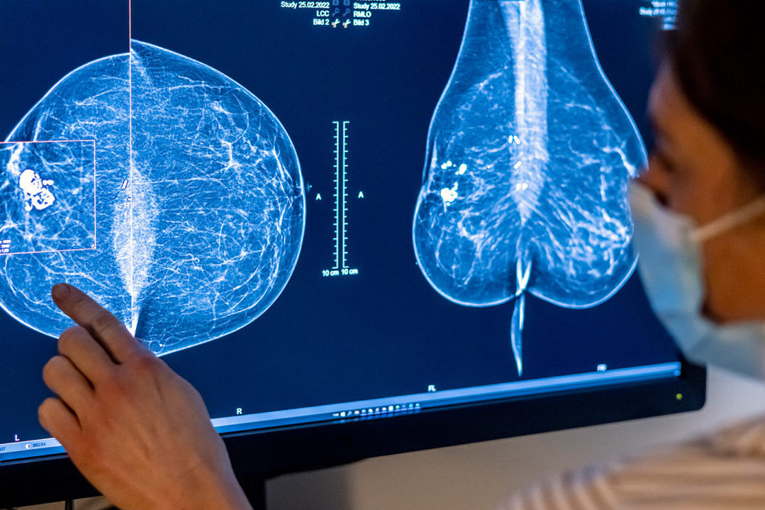 Breast density changes over time could be linked to breast cancer