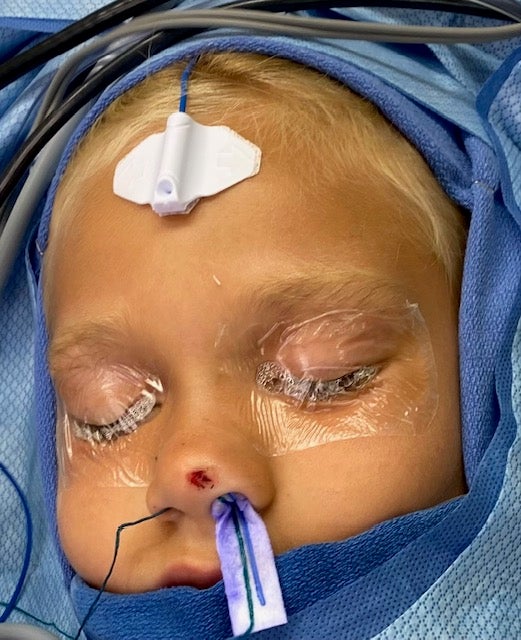 7-year-old Olivia needed emergency surgery at Riley Hospital for Children in Indianapolis after she was shot in the nose by a blow dart. (Provided Photo/IU Health)