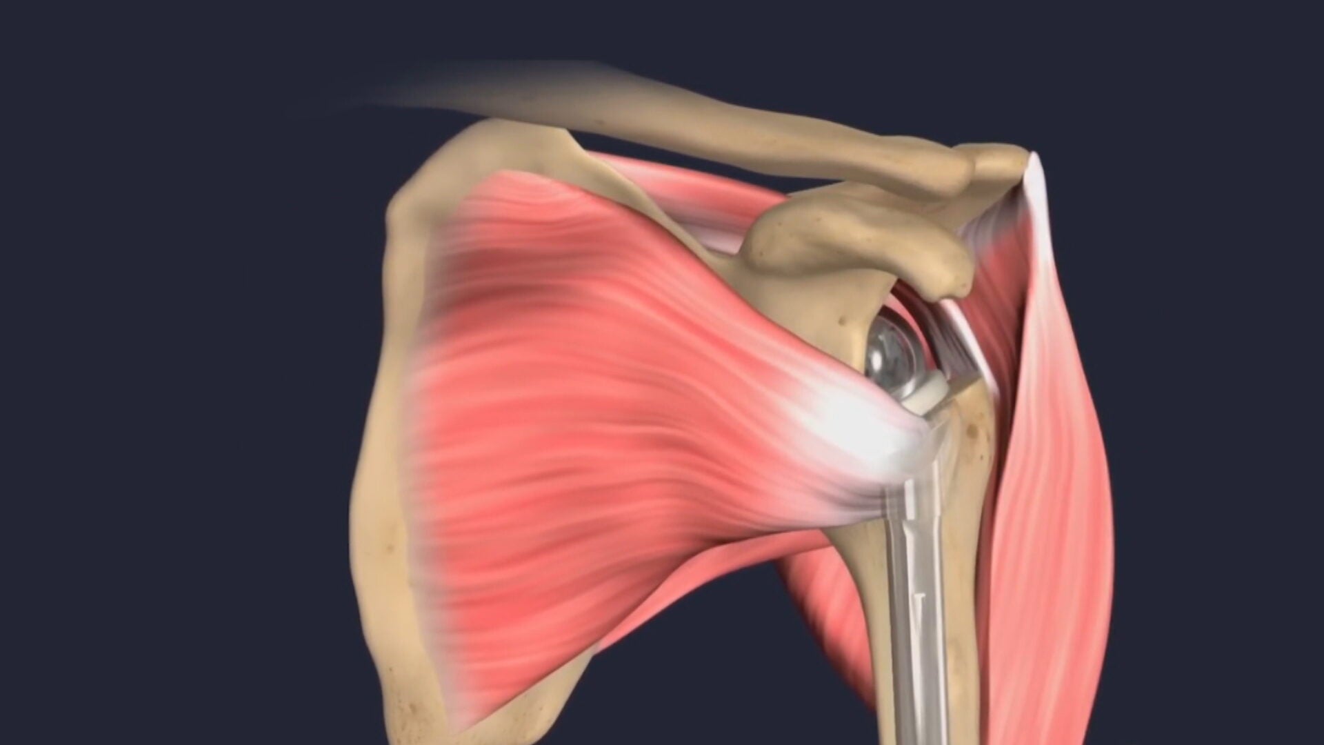 Health Spotlight | Reverse shoulder surgery